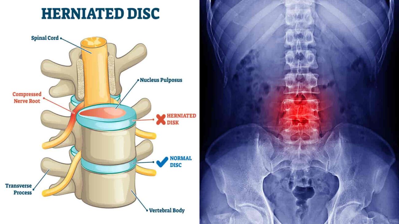 l4-l5 disc bulge treatment without surgery? symptoms, causes, exercises, treatments and medicine